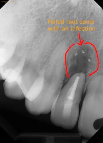 Failed root canal