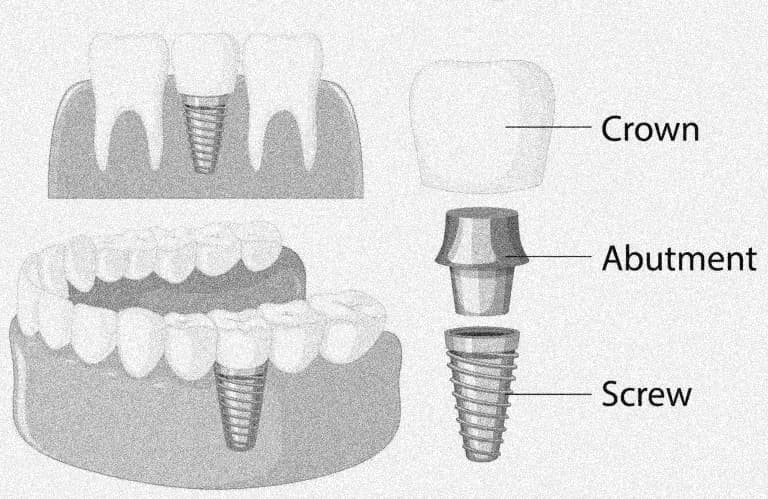 Crown placement