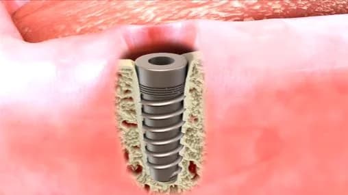 Placing dental implant