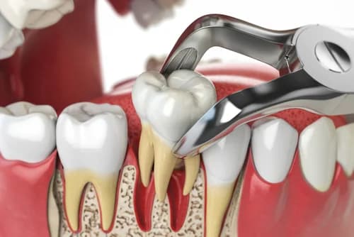 Removing unhealthy tooth