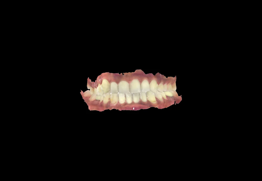 Intraoral impressions