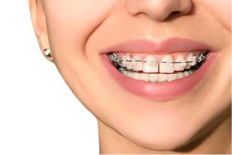 Clear Braces in Fremont: The Benefits and What They Accomplish
