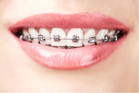 Palate Expanders From a Braces Dentist Near Me